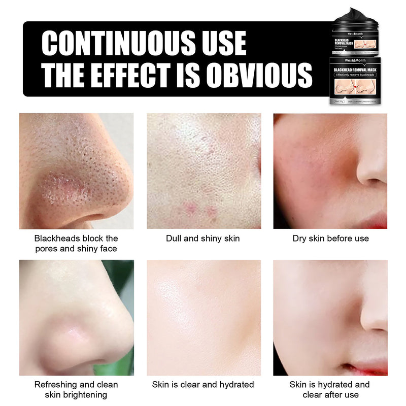 Blackhead Removal Mask - Deep Cleaning