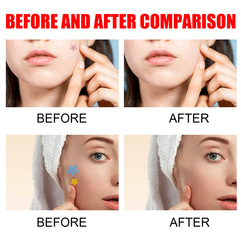 Hydrocolloid Acne Patches - Pimple Removal